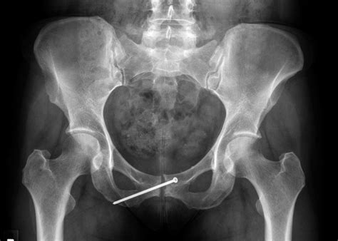 A 51-Year-Old Runner with Acute Hip and Groin Pain - JBJS ...