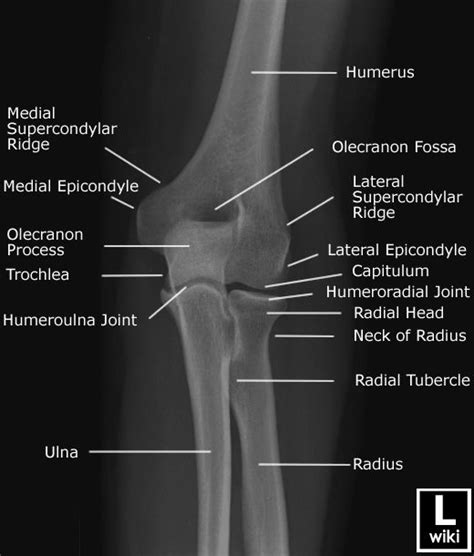 Elbow Radiographic Anatomy Wikiradiography Medical Knowledge Radiology Medical Anatomy