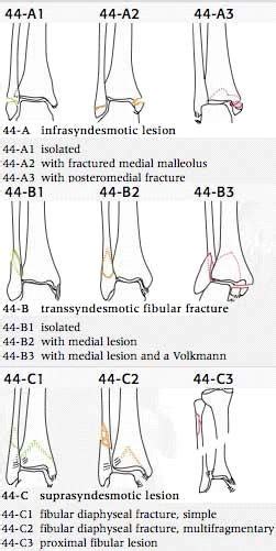 Ankle Fracture Classification