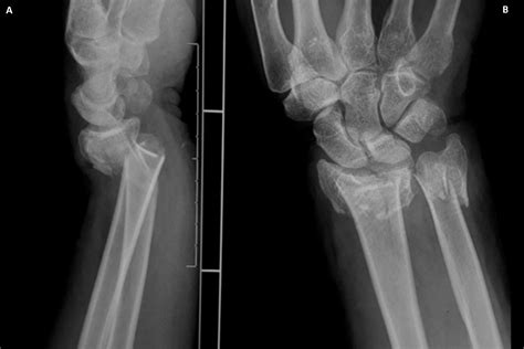 Cureus Simultaneous Fractures Of Distal And Proximal Ends Of Radius