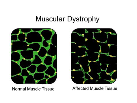 In Muscular Dystrophy The Affected Tissues Become Disorganized And The