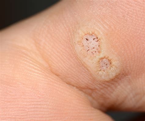 6 Ways To Avoid Plantar Warts This Summer — Amarillo Foot Specialists