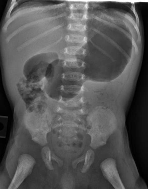 Hypertrophic Pyloric Stenosis Radiology Case