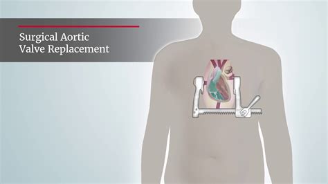 Aortic Stenosis Surgical Aortic Valve Replacement Procedure Youtube