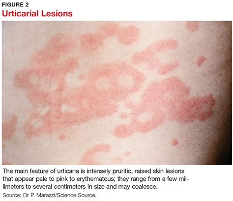 Chronic Urticaria Its More Than Just Antihistamines Clinician Reviews