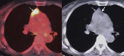 Imaging Of Thymus In Myasthenia Gravis From Thymic Hyperplasia To