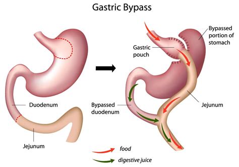 Gastric Bypass Surgery St Louis Mo Laparoscopic Gastric Bypass Surgery