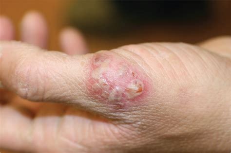 A Tender Rash On The Hand Dermatology Jama The Jama Network