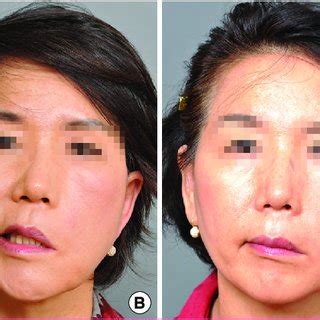 Facial Muscle Paralysis Telegraph