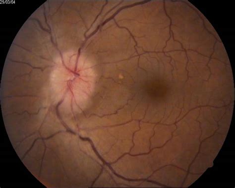 Optic Nerve Disease Eye Specialist Treatments Types And Symptoms