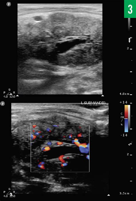 Ultrasound Diagnosis Of Sialolithiasis In A Patient With Jaw Pain And