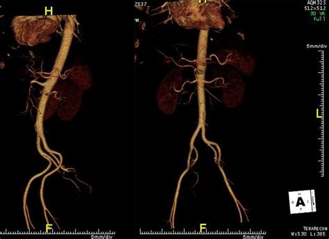 Ct Angiogram Of Abdominal Aorta Sagittal Plane On The Left And Coronal