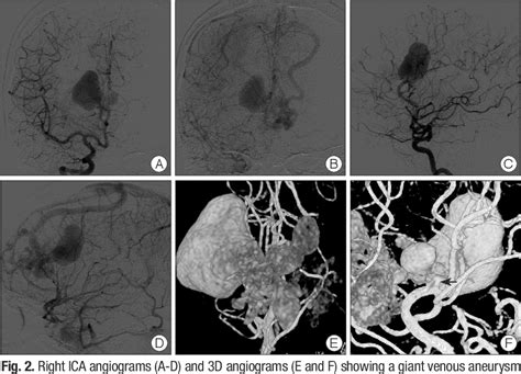 Figure From A Case Of Pial Arteriovenous Fistula With Giant Venous Aneurysm And Multiple