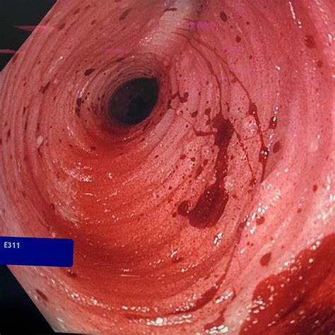 Bile consists of water, electrolytes, bile acids, cholesterol, phospholipids and conjugated bilirubin. Biliary Tract Model | Pulse Medical Demonstration Models