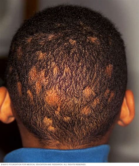 Tinea Capitis Scalp Ringworm Causes Symptoms Pictures And Treatment