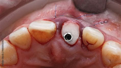 Temporary Dental Gingiva Former On The Abutment After Implantation