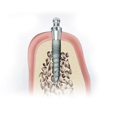 Implante Dental De Titanio CITO Mini DENTAURUM Tipo Bola Recto