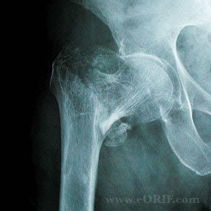 Intertrochanteric Femur Fracture S72.143A 820.21 | eORIF