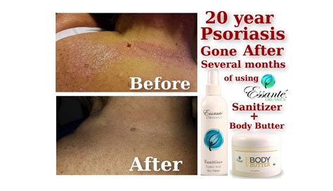 20 Year Psoriasis Skin Condition Vanishes After Using Essanté