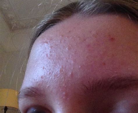 Mild To Moderate Forehead Acne General Acne Discussion
