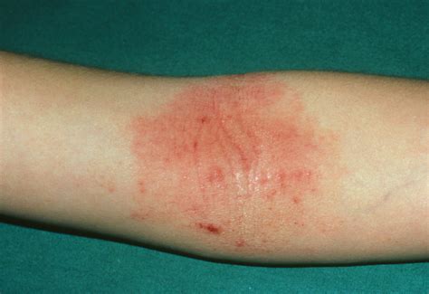 Dyshidrotic Eczema Arm