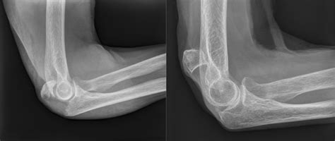Lateral Radiographs Of A Patient´s Olecranon Fracture Mayo Type Iia