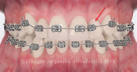 Orthodontic Emergencies Problems With Your Braces Jorgensen
