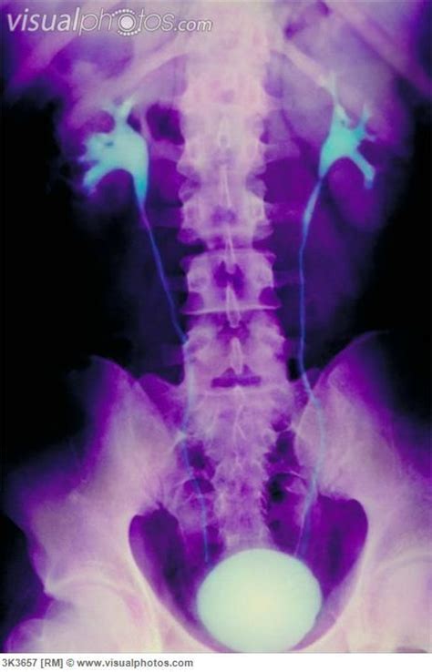 Intravenous Pyelogram Urinary Tract X Ray Color Enhanced Normal