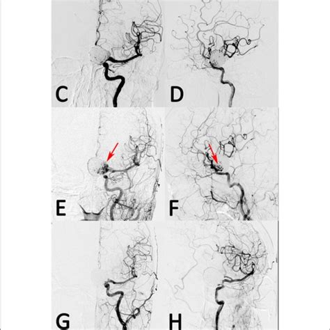 A Patient With Left Giant Posterior Communicating Artery Aneurysm Was Download Scientific
