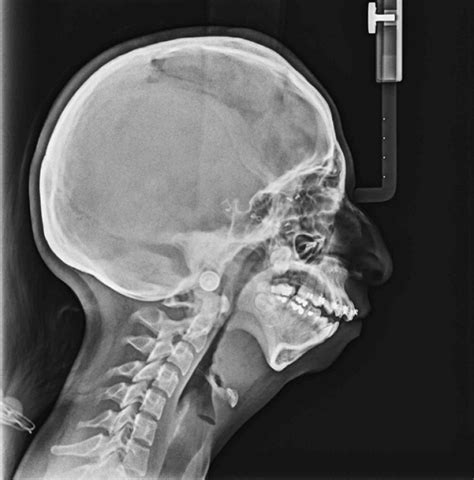 Indicaciones de la Radiografía Lateral de Cráneo Dento Metric Radiología Dental Oral y
