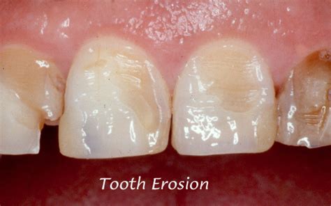 What Is Tooth Enamel Erosion Home