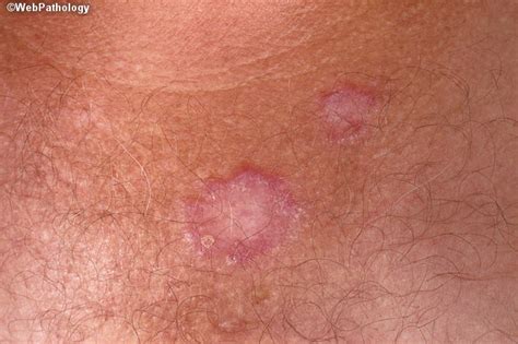 Lupus (systemic lupus erythematosus) causes symptoms like joint pain, tiredness and skin rashes. Webpathology.com: A Collection of Surgical Pathology Images