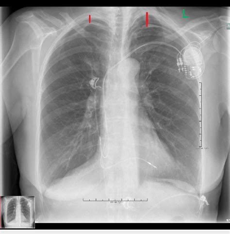Chest X Ray Shows Bilateral Apical Pneumothorax Red Arrows 3 Hours Download Scientific