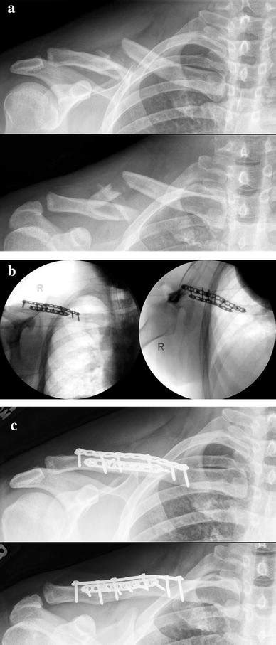 A Anteroposterior Ap And Caudal Tilt Injury Radiographs Of The