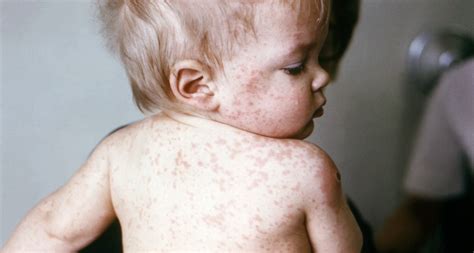 Us Outbreak Of Measles Emerges Science News For Students