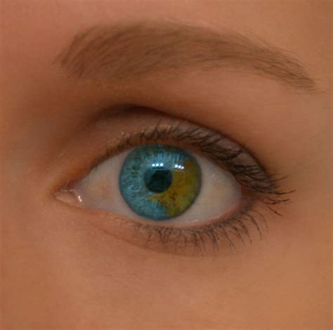 Sectoral Heterochromia Rare Eyes Aesthetic Eyes Heterochromia Eyes