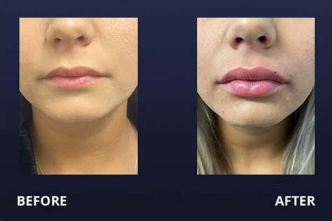 Lip Filler Before After Pictures Madnani Facial Plastic Surgery