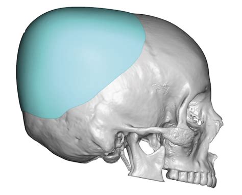 Plastic Surgery Case Study Large Two Stage Skull Implant Augmentation