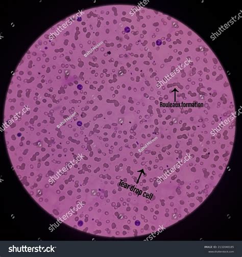 Microscopic Image Macrocytic Anaemia Thrombocytopenia Folic Stock Illustration 2132040185