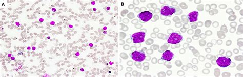 A Peripheral Blood Smear Shows Leukocytosis With Many Immature Looking