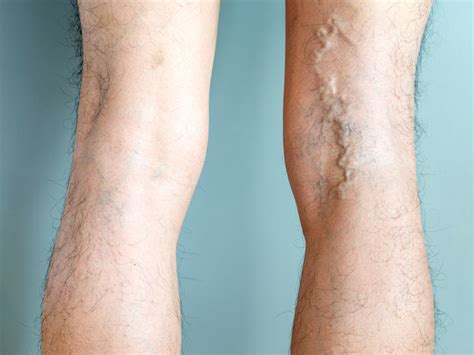 Treatments include sclerotherapy and surgery. Varicose Vein Stripping: Purpose, Procedure, and Risks