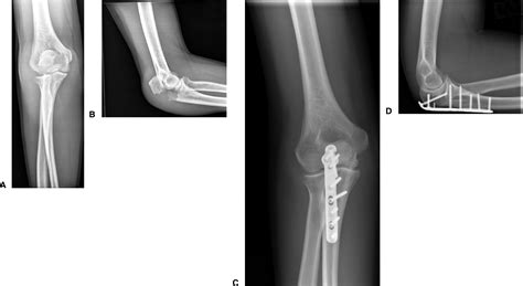 Proximal Ulna Fractures Journal Of Hand Surgery