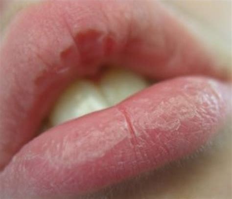swollen chapped lips pictures photos