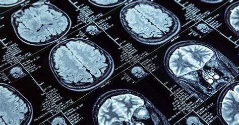 Diagnose Hirntod Wenn Tote Noch Lebendig Wirken Magnetic Resonance