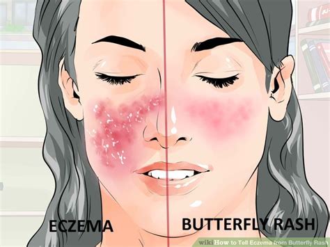 How To Tell Eczema From Butterfly Rash 6 Steps With Pictures Lupus