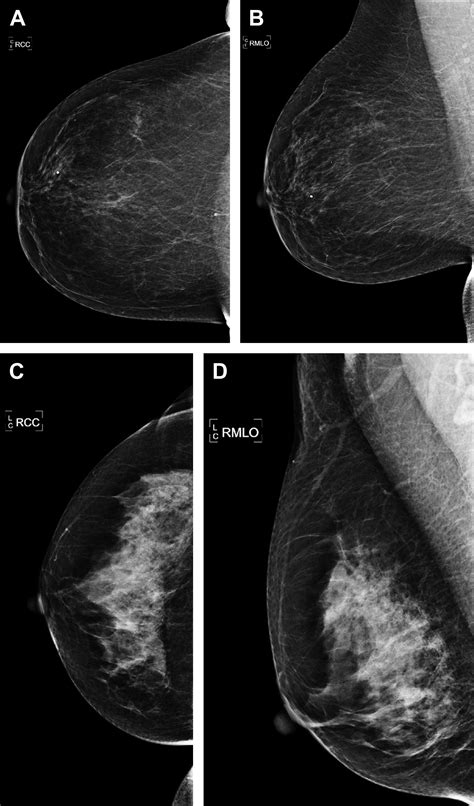 Screening Imaging And Image Guided Biopsy Techniques For Breast