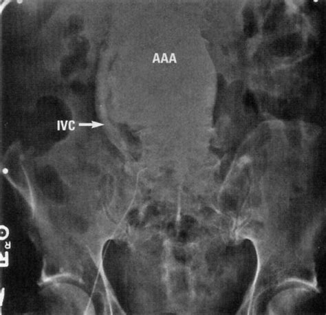 Spontaneous Aortocaval Fistula Annals Of Emergency Medicine