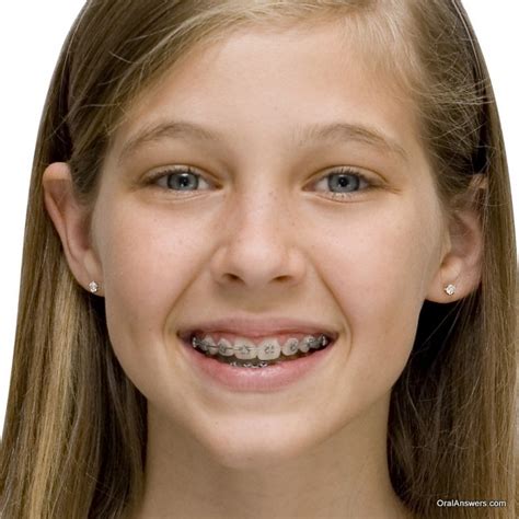 60 Photos Of Teenagers With Braces Robweigners Blog