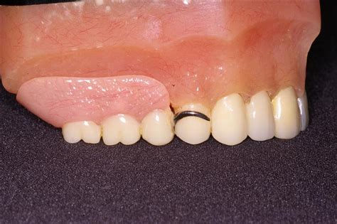 Removable Partial Denture Ask A Dentist