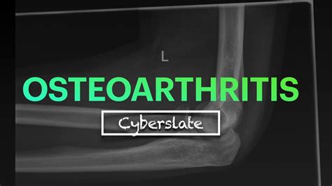 Osteoarthritis Part 01 Introduction Youtube